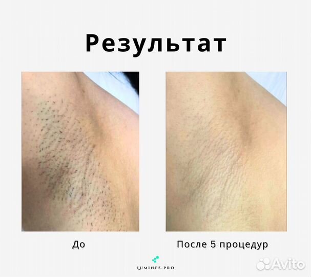 Диодный лазер Lumines Max'One 1200w, новинка 2024