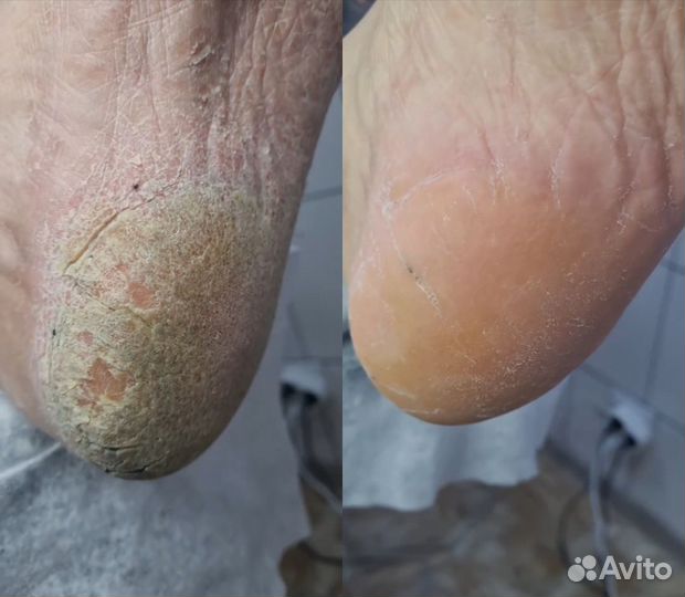 Подолог. Педикюр проблемной стопы