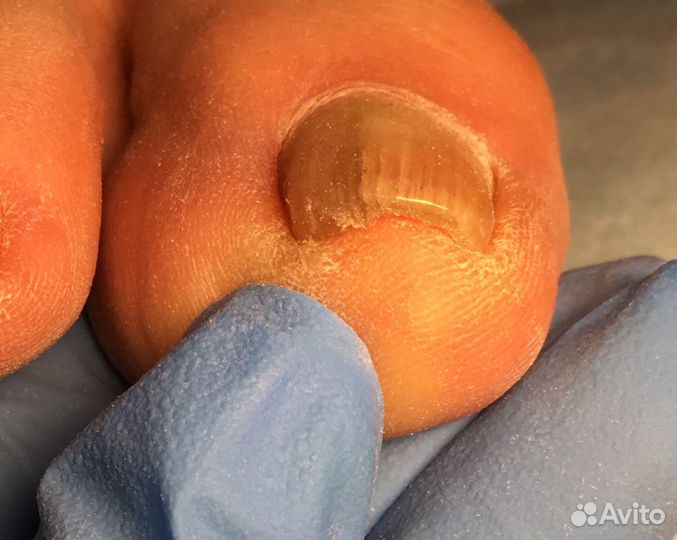 Аппаратный педикюр.Лечение вросшего ногтя, установ