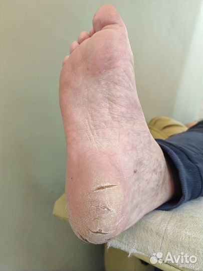 Коррекция вросшего ногтя