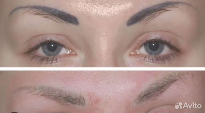 Удаление татуажа ремувером