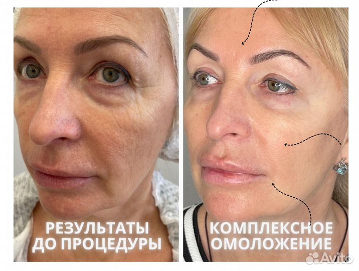 Комплексная программа омоложения лица