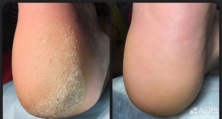 Педикюр аппарат