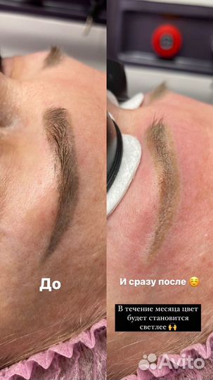 Удаление татуажа