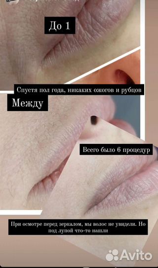 Электроэпиляция