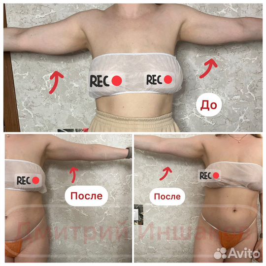 Армопластика Ручная липосакция Массаж