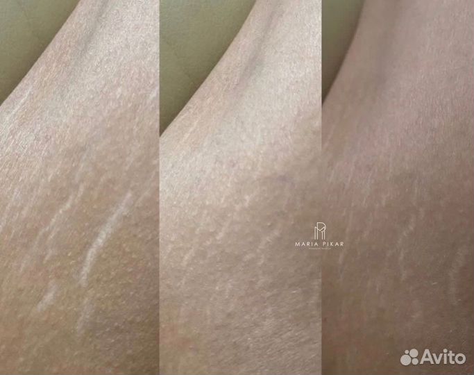 Камуфляж шрамов, рубцов, растяжек, витилиго