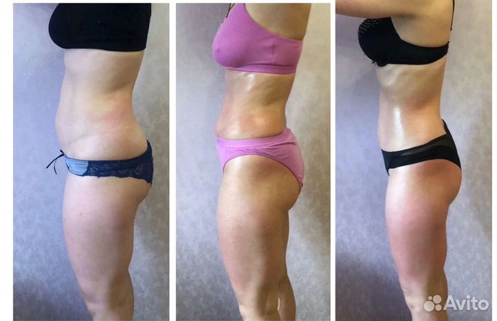 Массаж Аппаратный, Кавитация, RF-Лифтинг Вакуумный