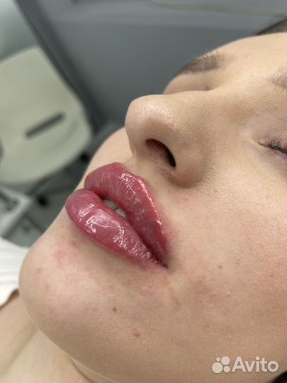 Контурная пластика губ