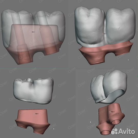 Blender for Dental (B4D) iBar балки и все модули