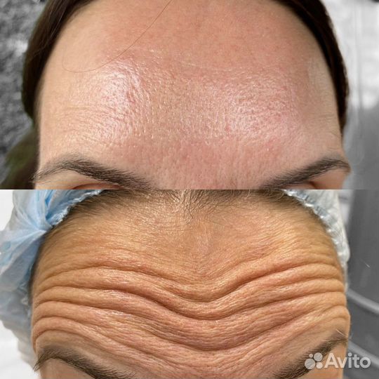 Ботулинотерапия