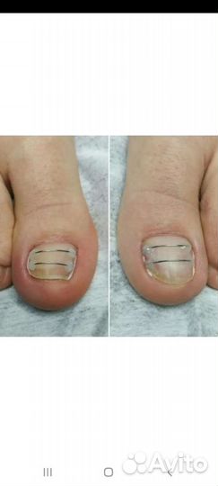 Педикюр(подология)