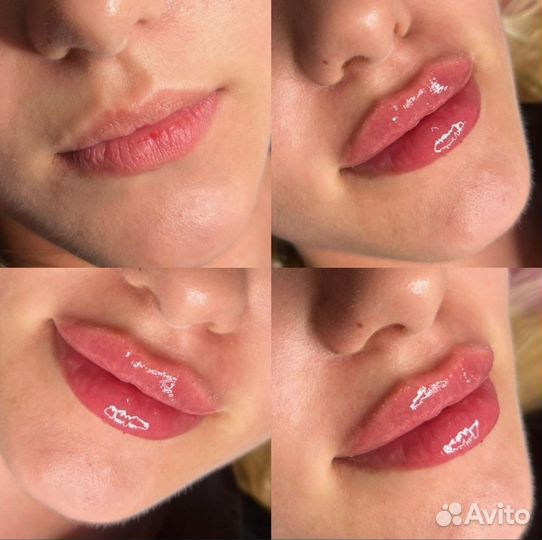 Увеличение губ