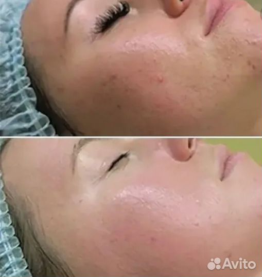 Пилинг для лица Биорепил