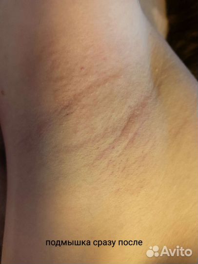 Электроэпиляция