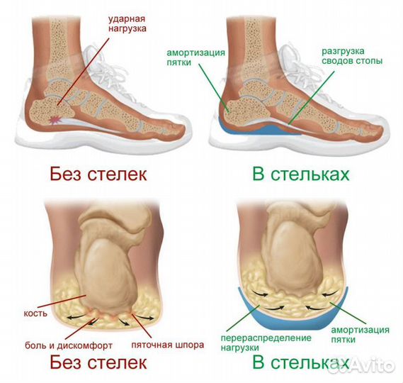Стельки при плоскостопии заказать