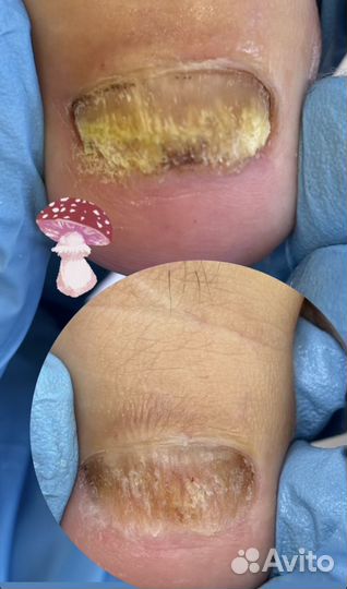 Восстановление ногтей из различных состояний