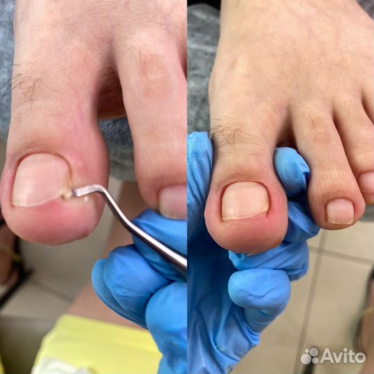 Медицинский педикюр (подология )