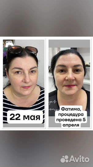 Минус 10 лет за одну процедуру СМАС лифтинг