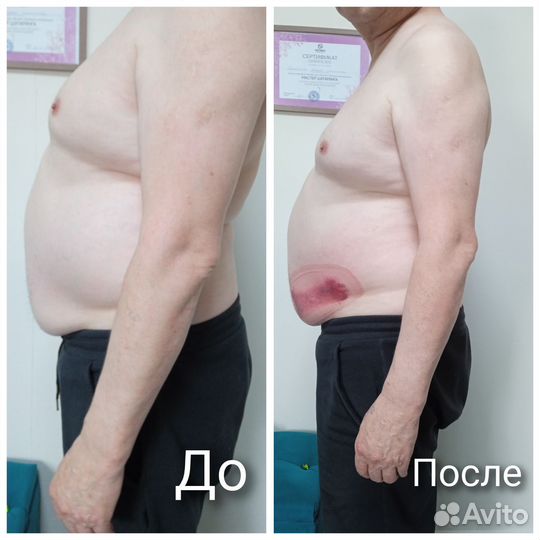 Похудение