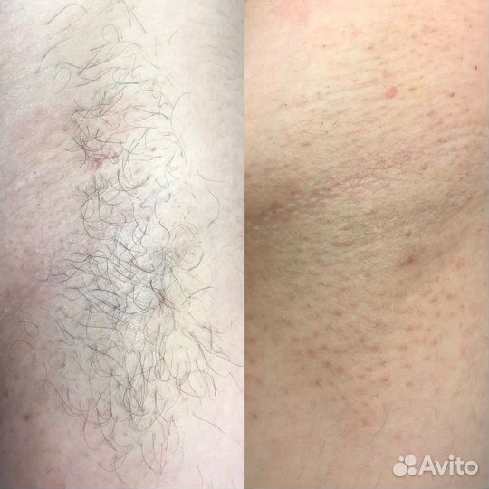 Электроэпиляция