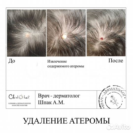 Удаление папиллом, родинок, бородавок