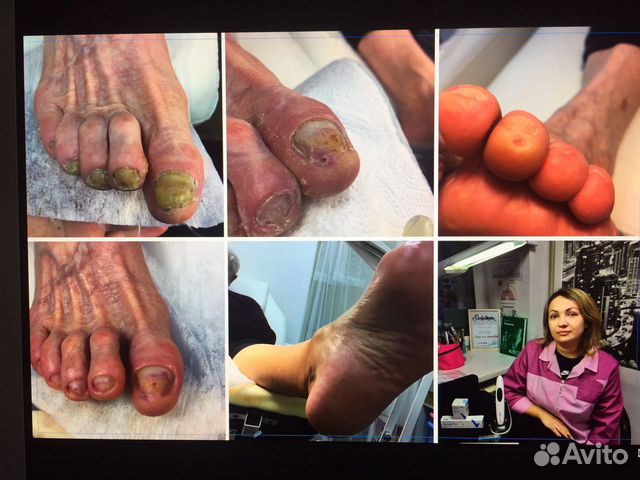 Вросший ноготь, бородавки, педикюр, грибок ногтей