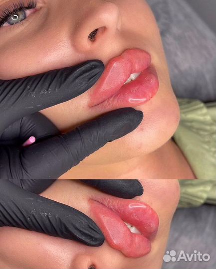 Увеличение губ