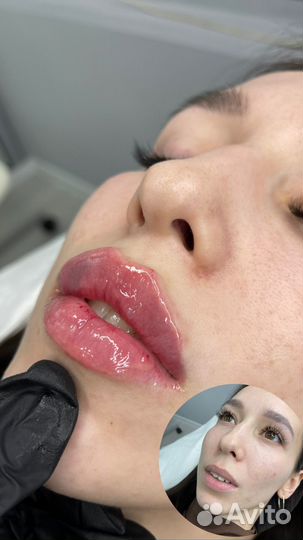 Контурная пластика губ