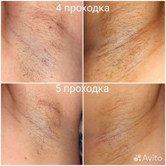 Электроэпиляция