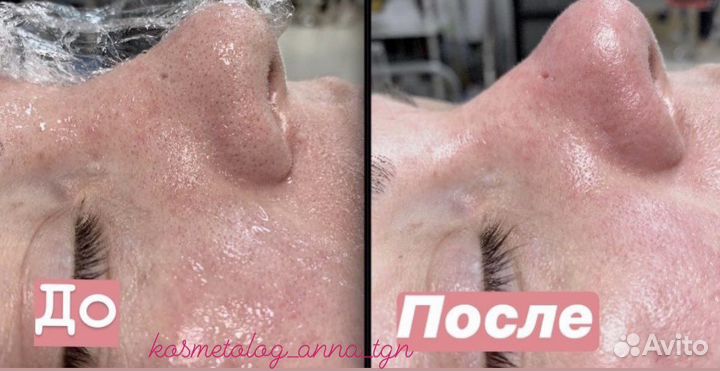Чистки, пилинги, уходовые процедуры, массаж лица