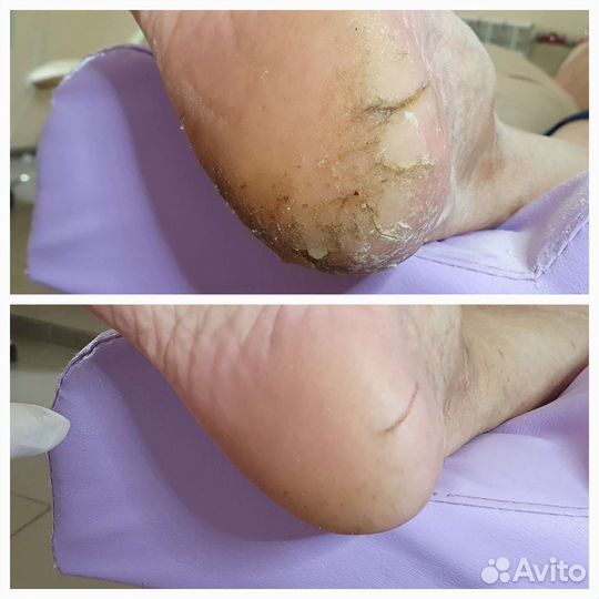 Лечение вросших ногтей