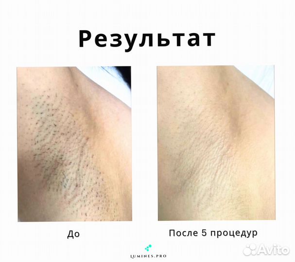 Диодный лазер Lumines MaxOne 1200 Вт