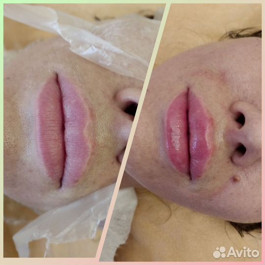 Увеличение губ Косметолог Нити Ког Акне Ботокс