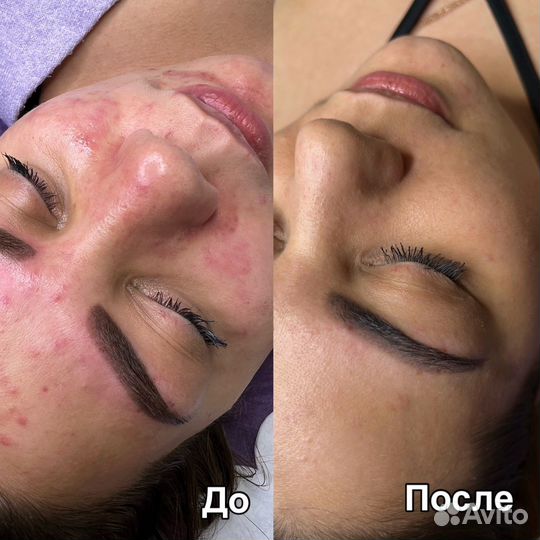 Косметолог/чистка лица/пилинг