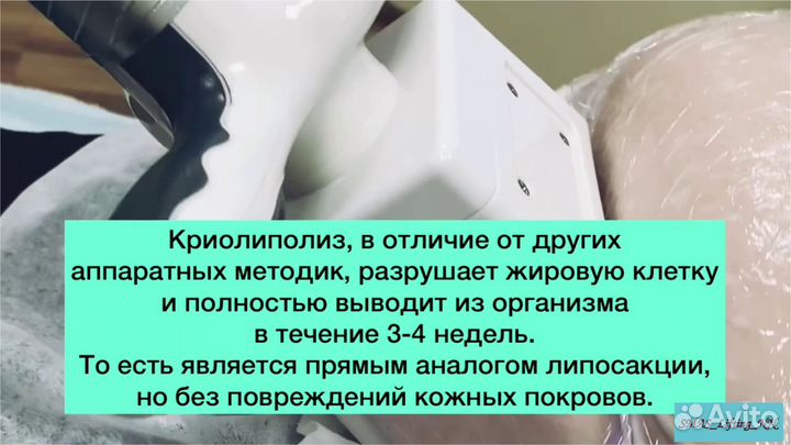 Криолиполиз, смас-липосакция