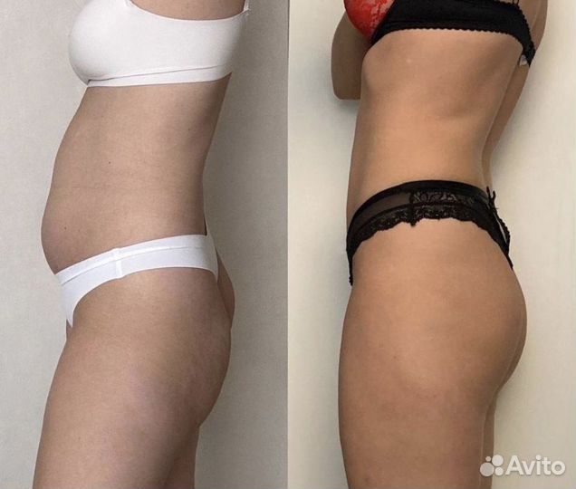 LPG массаж. Похудение