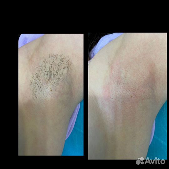 Spa шугаринг (сахарная депиляция)