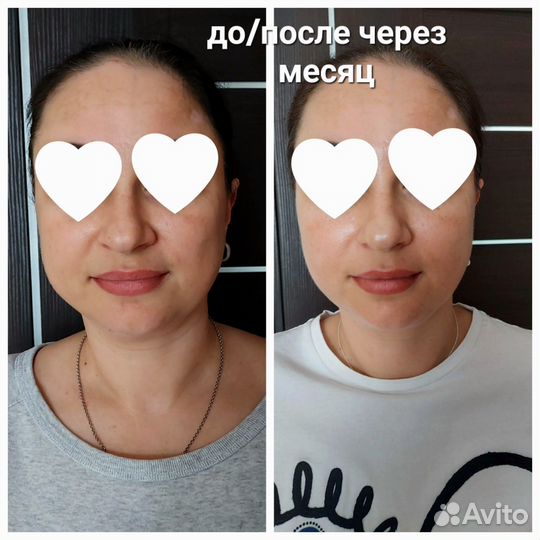 Смас лифтинг тела