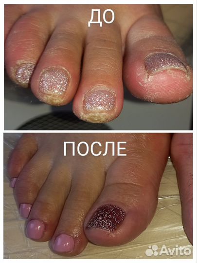 Полология. Ортониксия. Титановая нить