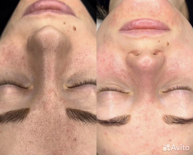 RF лифтинг, фотоомоложение,карбоновый пилинг,кавит