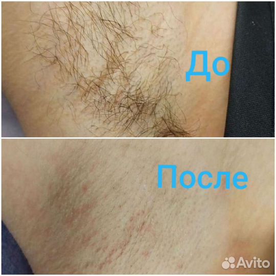 Электроэпиляция