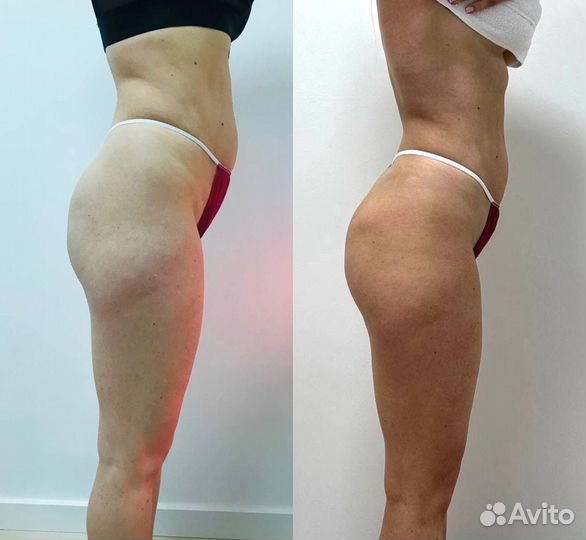 Аппаратный массаж RSL скульптурирование