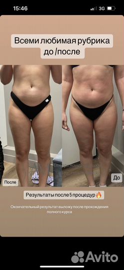 Lpg,коррекция фигуры