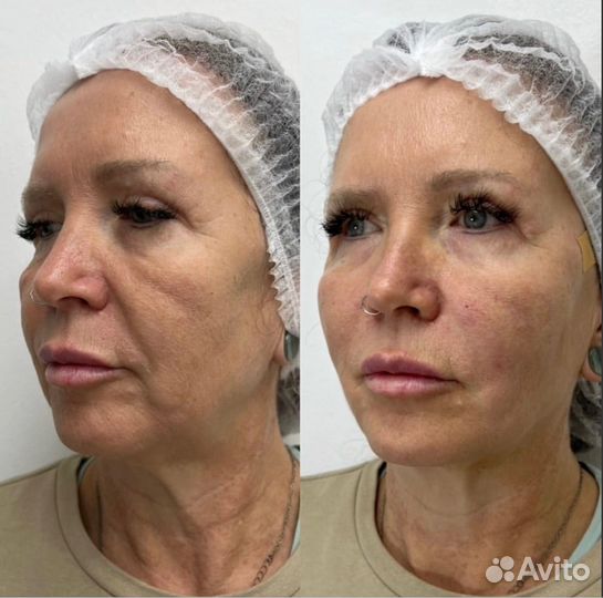 Smass lifting смасс подтяжка нитями