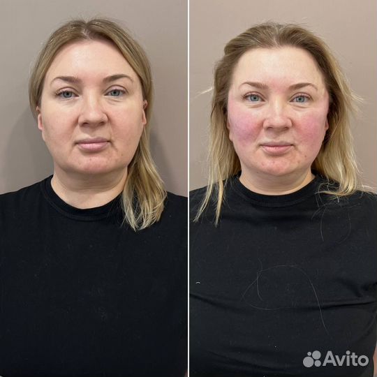 Нитевой лифтинг лица