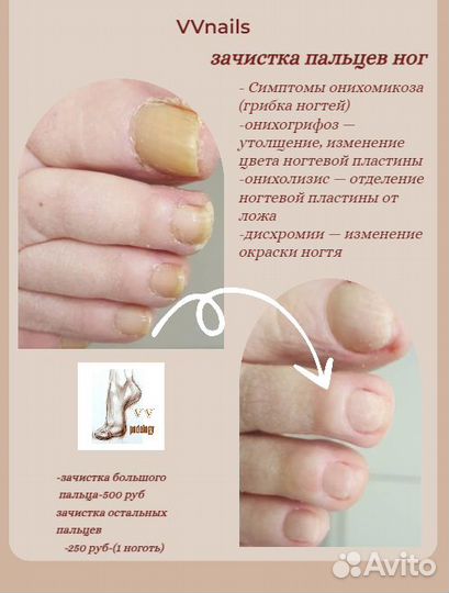 Лечебный педикюр подолог