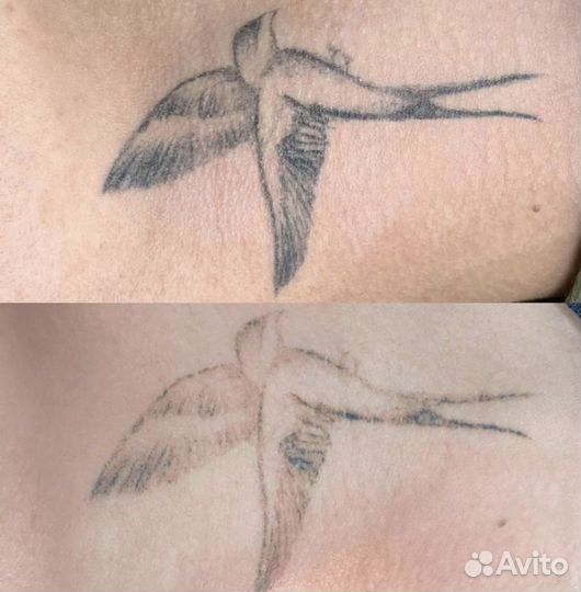 Лазерное удаление татуажа и тату, и ремувером