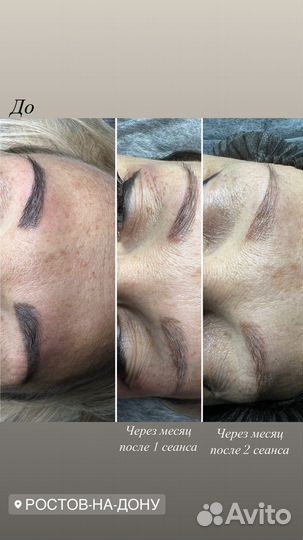 Лазерное удаление татуажа/тату