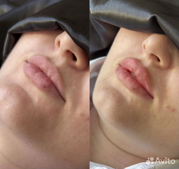 Увеличение губ